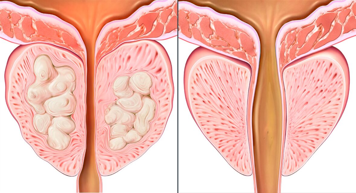 Etapy liečby prostatitídy s Prostalixom